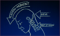 Illustration of Roof Crash and Neck Injuries
